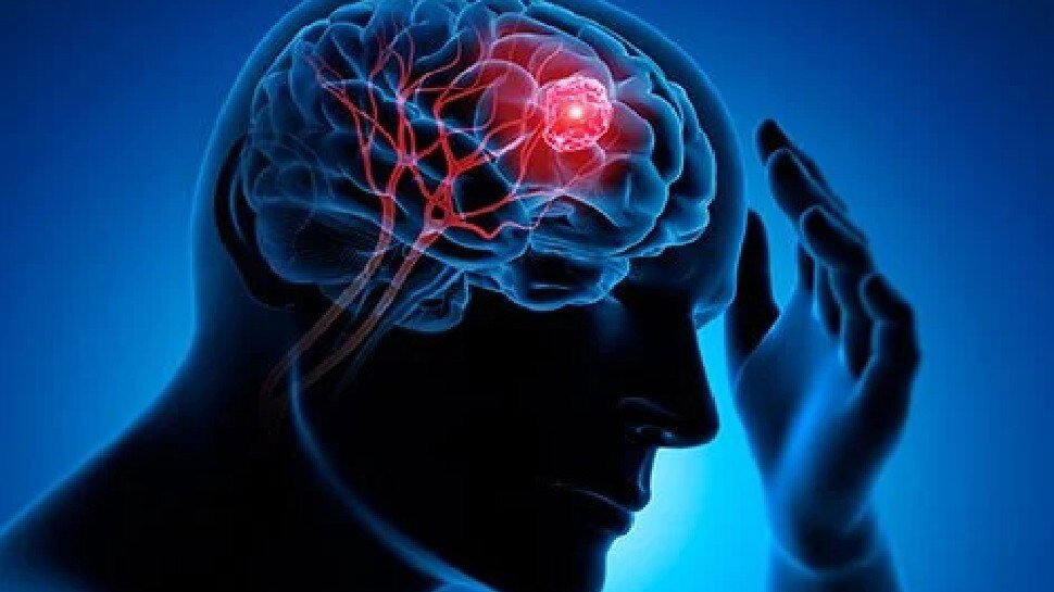 Brain Tumor: यूरिन की जांच से भी पता लगाया जा सकता है ब्रेन ट्यूमर, वैज्ञानिकों ने किया दावा