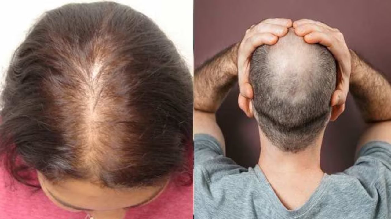 Hair Care Tips: देश में आधे युवा गंजेपन के शिकार, इसी में छिपी है भारत की कॉस्मेटिक इंडस्ट्री की ग्रोथ की रफ्तार