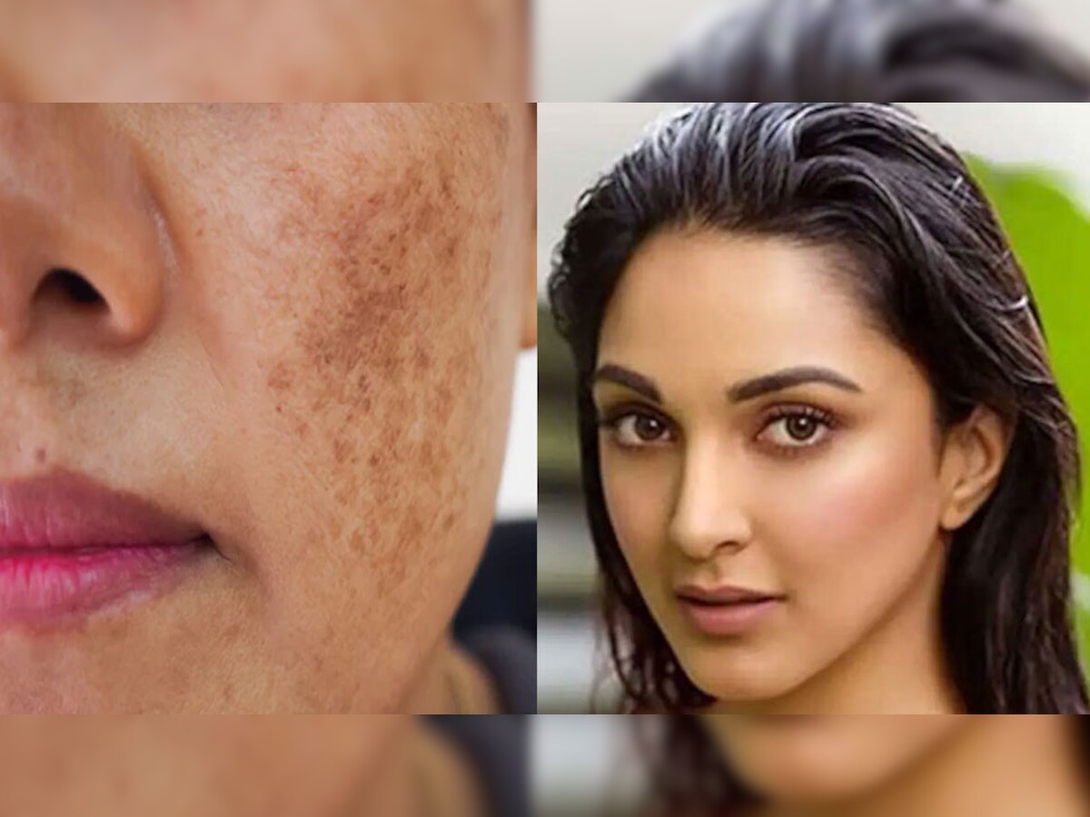 Skin Care: इन देसी इलाज के जरिए गायब होंगे दाग-धब्बे, Kiara Advani जैसा खिल जाएगा चेहरा