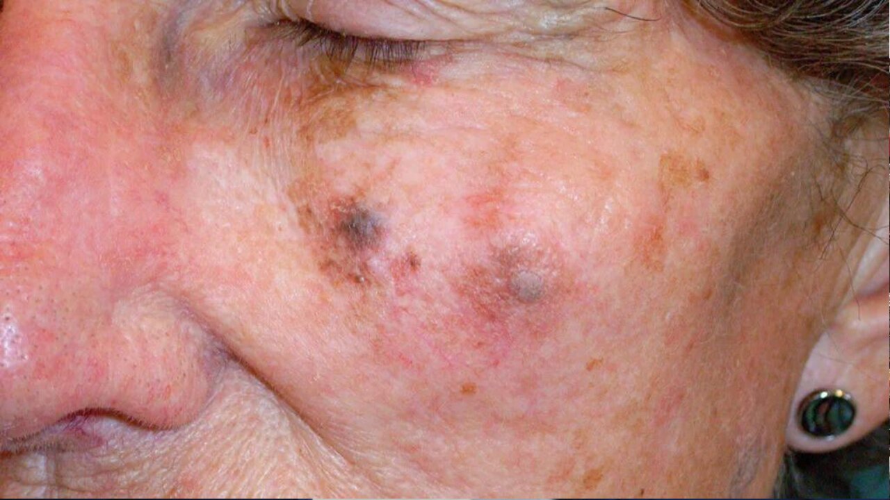 Skin Cancer: इन लोगों को सबसे ज्यादा खतरा, जानें क्या हैं इस बीमारी के कारण और बचाव