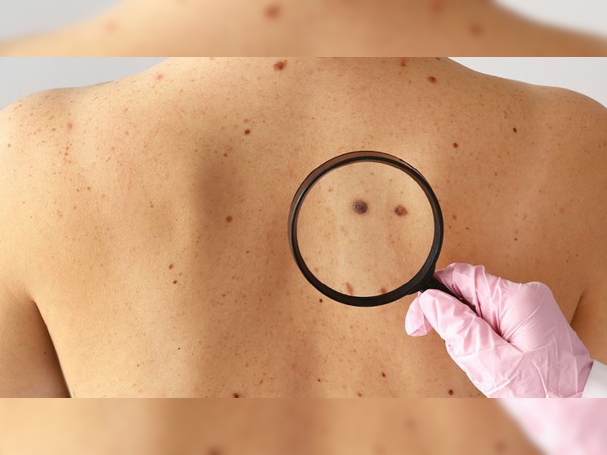 Skin Cancer का खतरा श्वेत लोगों में अधिक, सूर्य से संपर्क कम करने के लिए इन तरीकों को करें फॉलो