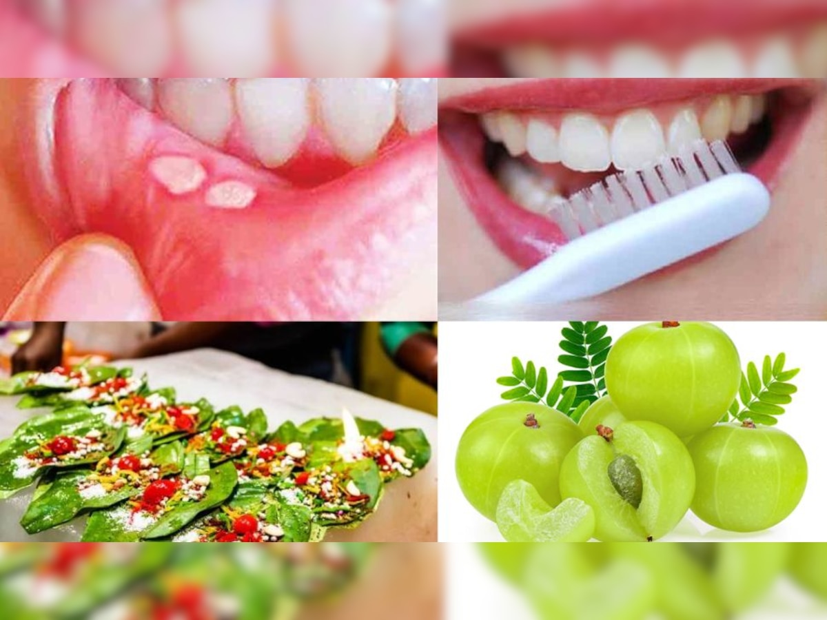 Mouth Ulcers tips
