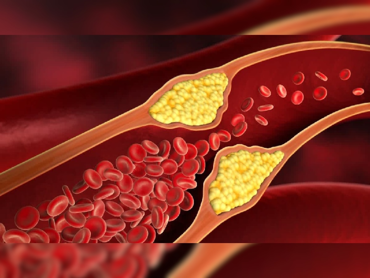 इस अंग को डैमेज कर सकता है हाई कोलेस्ट्रॉल, जानें Bad Cholesterol का लेवल अचानक बढ़ने से शरीर में क्या होता है?
