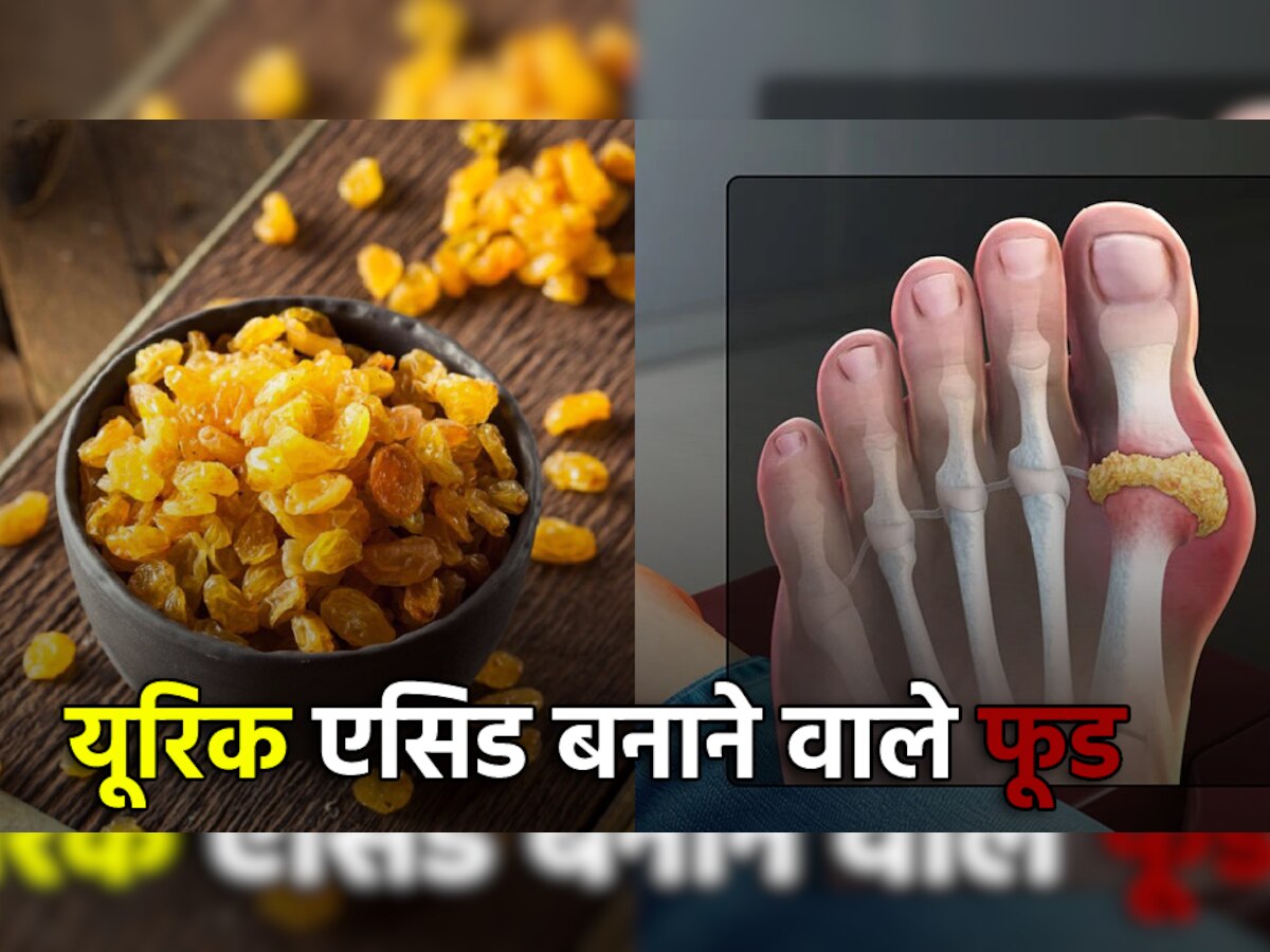 ये 5 फूड पेट में बनाते हैं भयंकर Uric Acid, ज्यादा ना करें सेवन वरना किडनी में हो जाएगी पथरी