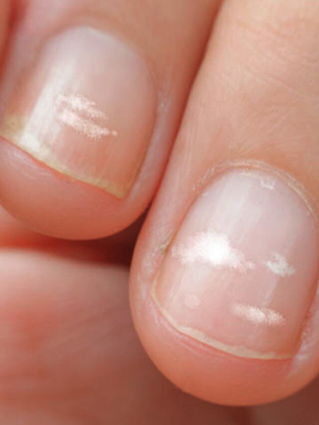White Spots On Nails: Meaning And Significance in Astrology - InstaAstro