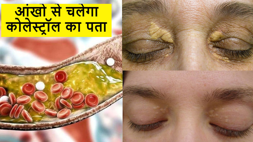 High Cholesterol can cause Yellow Lumps Deposits Near Xanthelasma Eyes