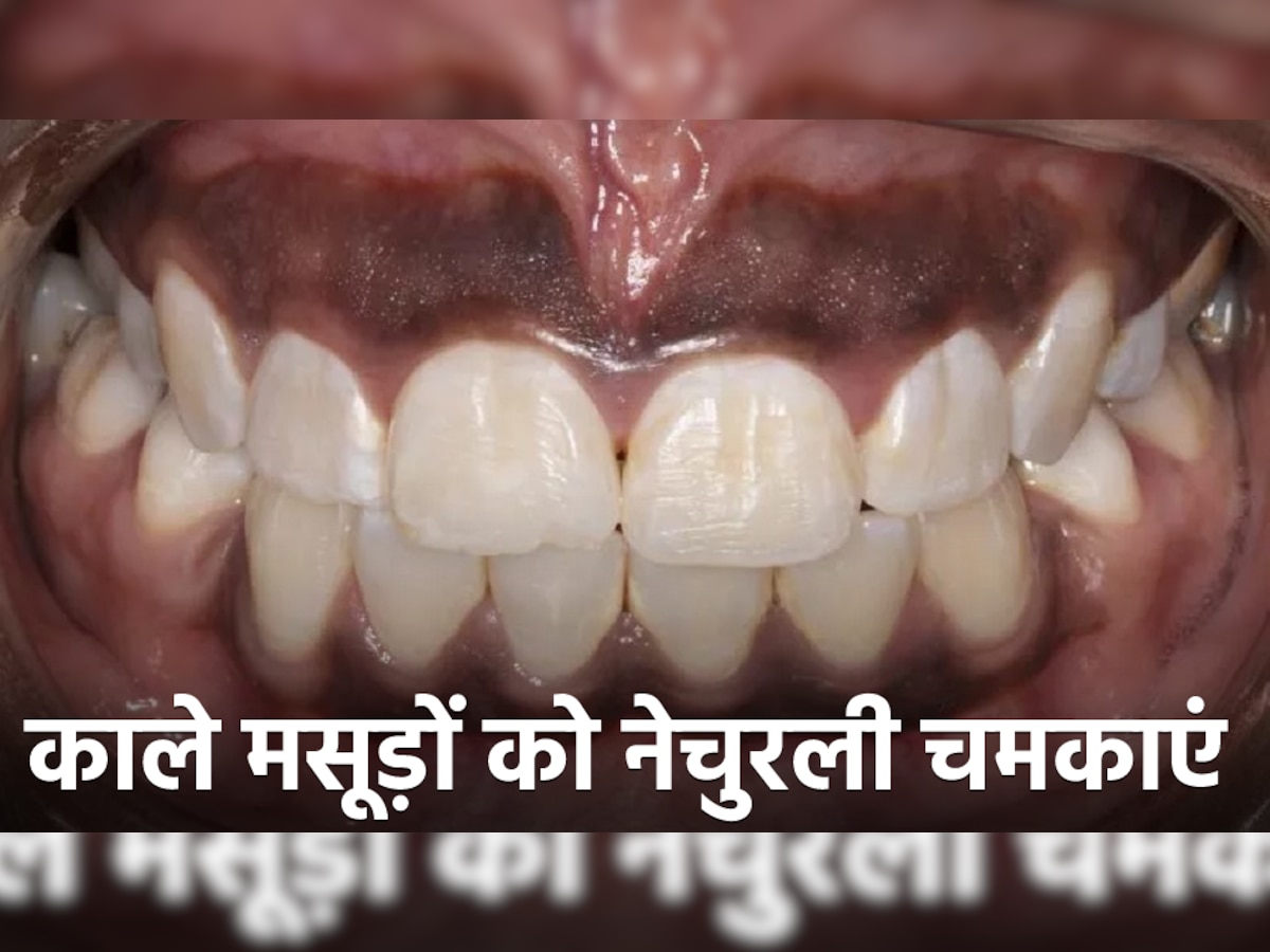 Black Gums: मसूड़ों के कालेपन ने कर दिया है शर्मिंदा? इन घरेलू नुस्खे से चमकाएं अपने मसूड़े