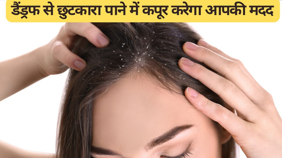 hair care tips apply camphor like this to get rid of dandruff Hair