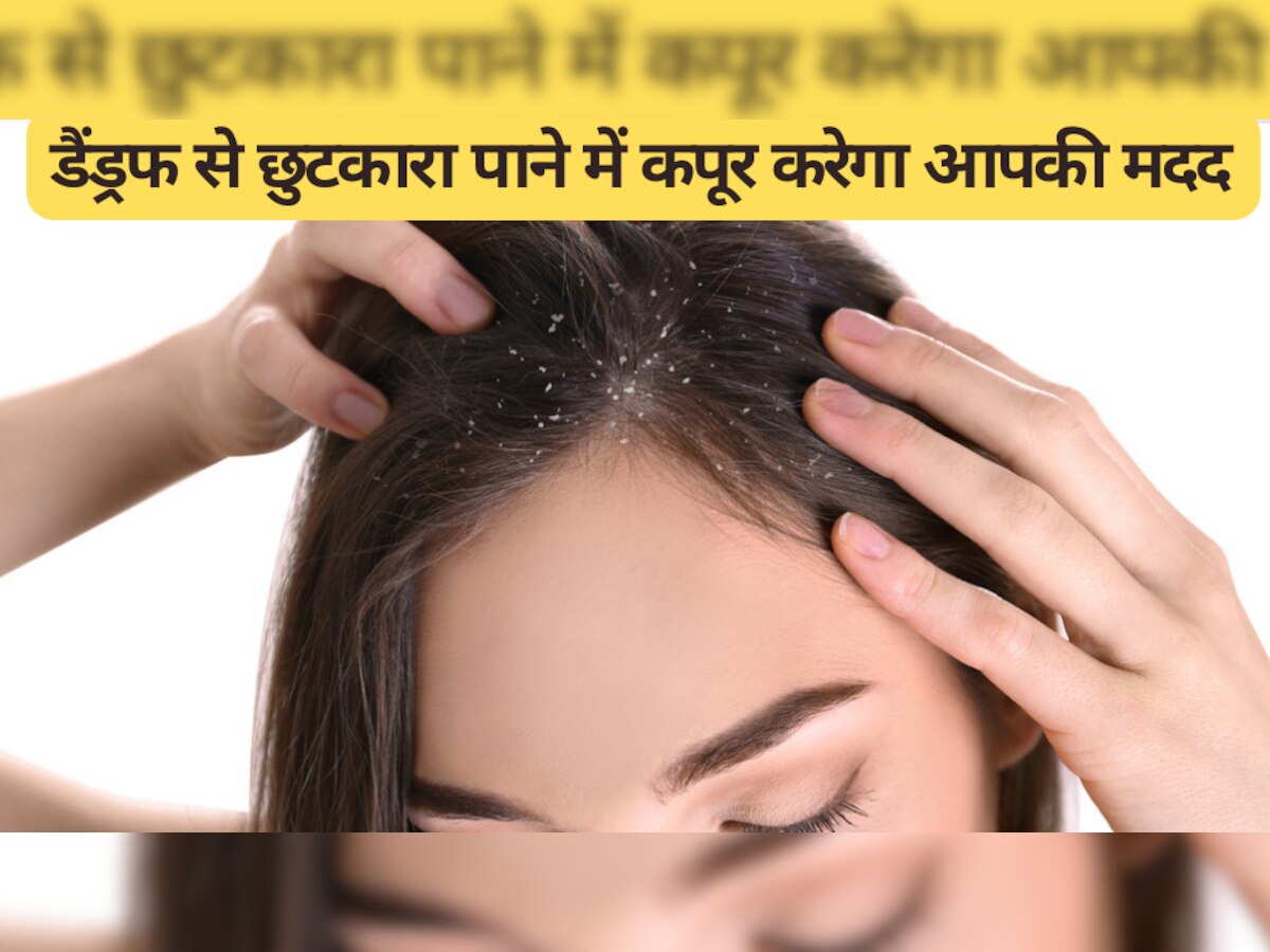 Hair Care Tips: डैंड्रफ से पाना है छुटकारा? कपूर करेगा आपकी मदद, ये है लगाने का सही तरीका