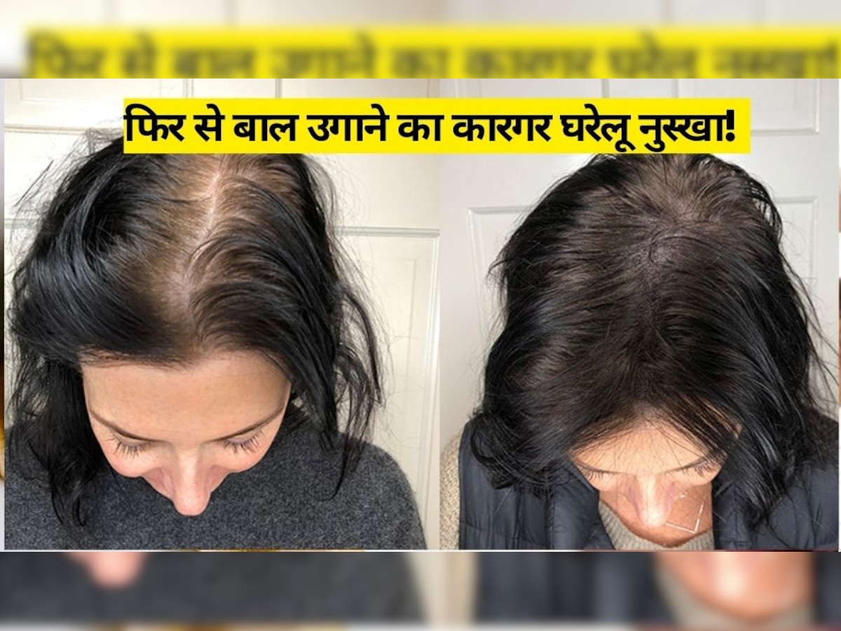 Hair Growth Tips: गुच्छों में गिरकर टूट रहे हैं बाल, गंजा होने से पहले आजमा लें ये आसान नुस्खा