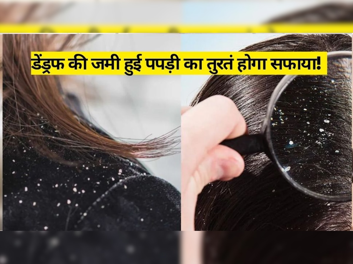 How To Remove Dandruff: बालों में जमी हुई है डेंड्रफ की पपड़ी, आंवले में मिलाएं ये चीज, तुरंत होगा सफाया