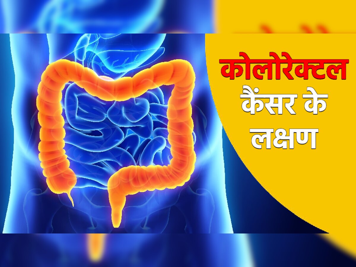 Colorectal Cancer Symptoms: भारत में तेजी से बढ़ रहे आंत के कैंसर के मामले, जनिए लक्षण और बचाव के तरीके