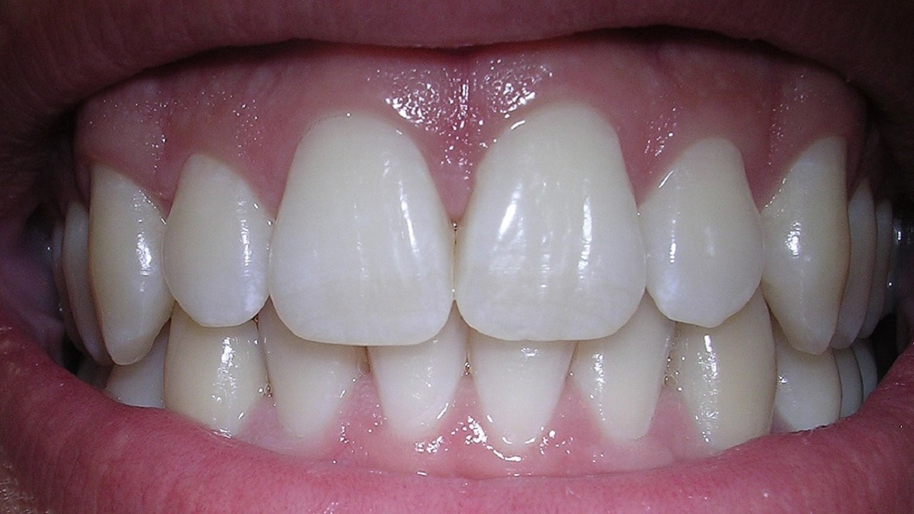 White Teeth Tips: इन आसान तरीकों से आप भी पा सकते हैं- स्वस्थ, सफेद व चमकीले दांत