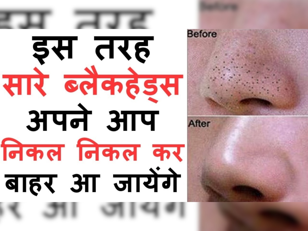 Blackheads Treatment: नाक के जिद्दी ब्लैकहेड्स से चेहरा दिख रहा है गंदगी भरा, ये घरेलू उपाय आएंगे आपके काम