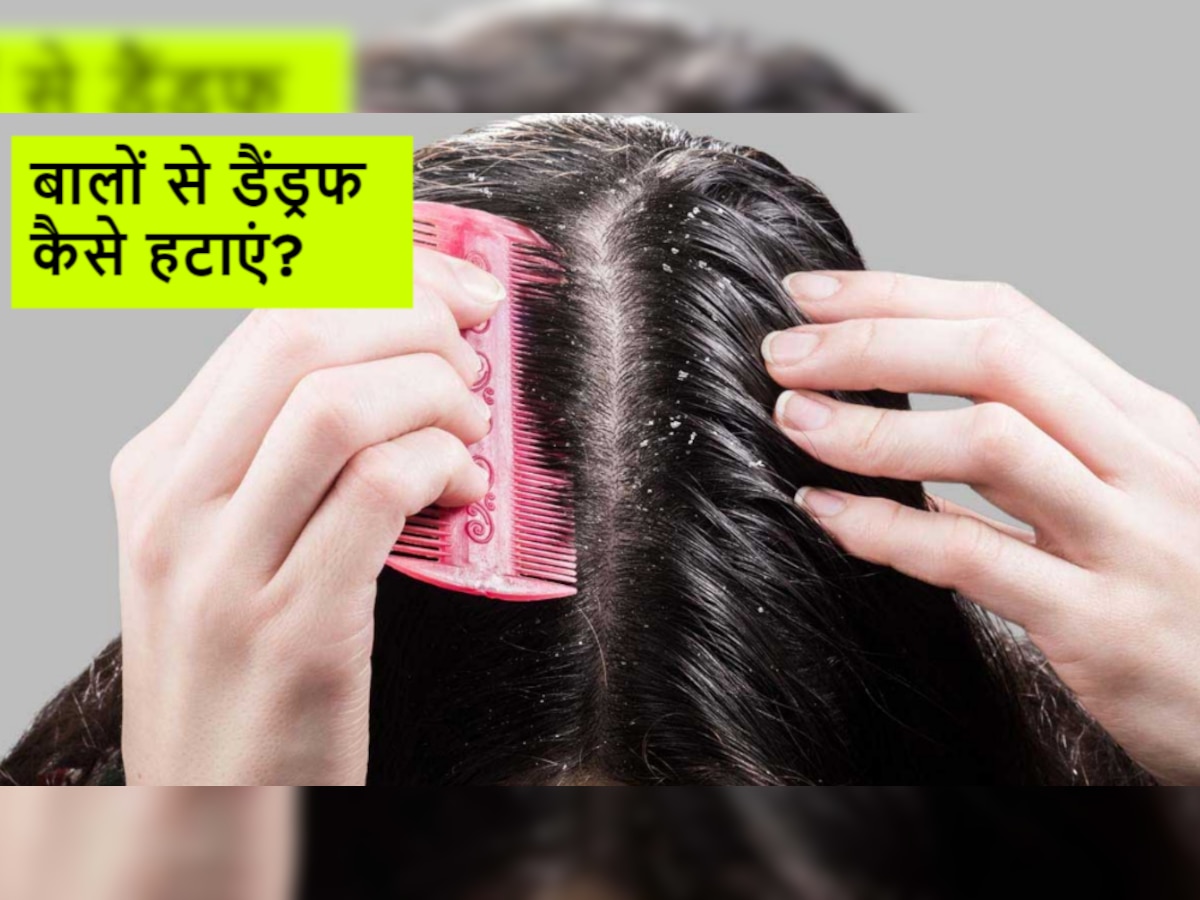 Dandruff Removing Tips: सिर्फ इन 5 बातों का रखेंगे ध्यान तो Dandruff कभी नहीं करेगा परेशान!