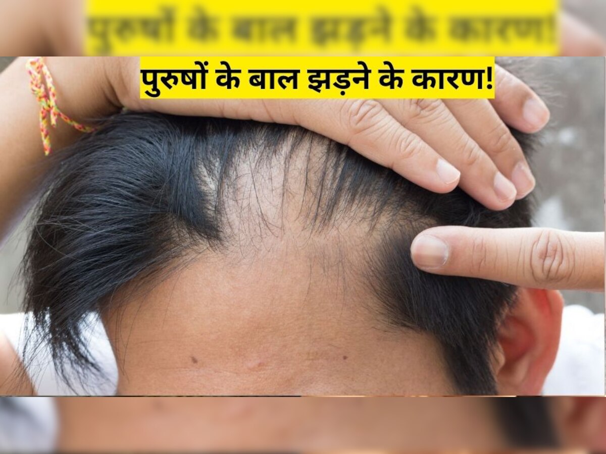 Men Hair Fall Treatment: पुरुषों में इन कारणों से झड़ने लगते हैं बाल, ध्यान में रखें ये बातें कंट्रोल होगा Hair Fall