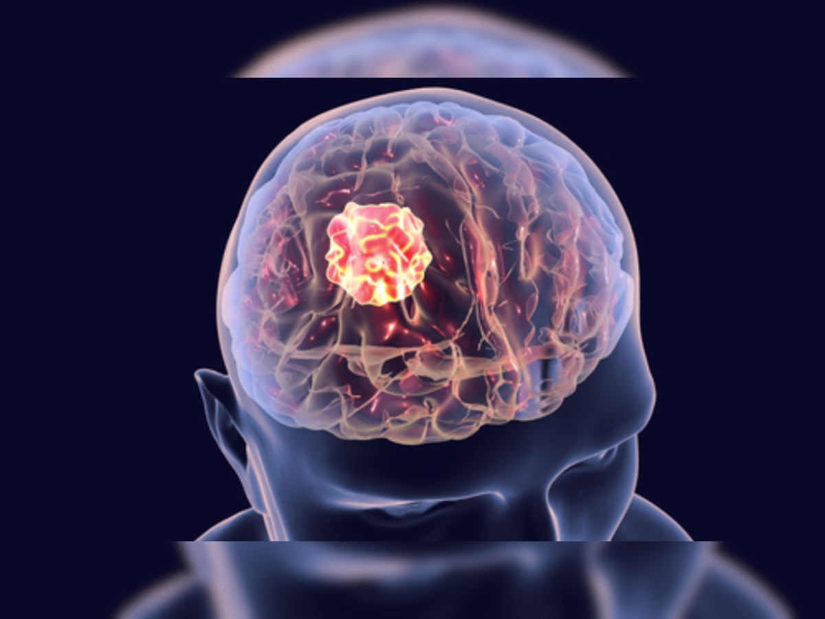 Brain Tumor: ब्रेन ट्यूमर के इन लक्षणों को ना करें अनदेखा, जरा सी लापरवाही हो सकती है घातक!