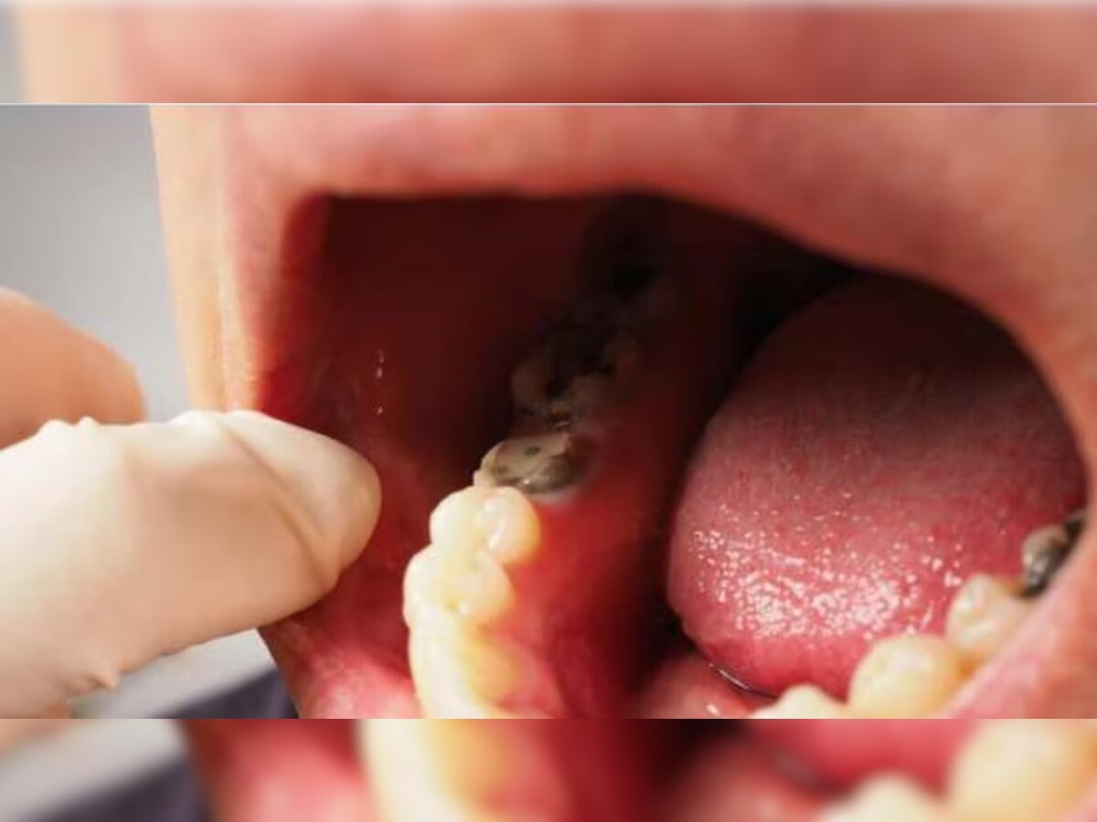 Teeth Cavities: इन चीजों को खुद से रखे दूर, कभी नहीं होगी दांतों में समस्या!