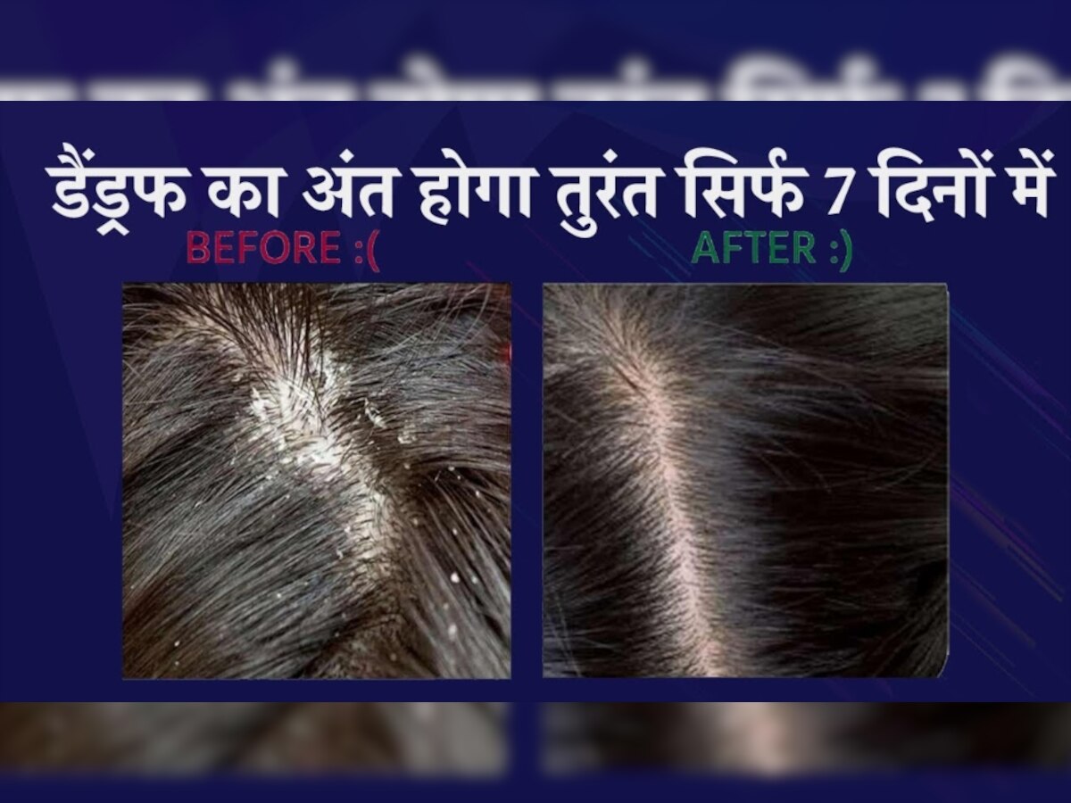 Dandruff Solution: डेंड्रफ की जमी पपड़ी को हफ्तेभर में निकाल बाहर कर देगा ये कच्चा फल, बस ऐसे करें इस्तेमाल