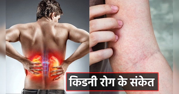 Kidney Disease: Itchy skin and unusual rashes gives warning signs of ...