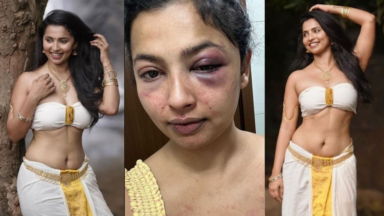 Anicka Vikhraman Assaulted: एक्स बॉयफ्रेंड ने एक्ट्रेस को बेरहमी से पीटा, चेहरा सूजा इतना कि पहचानना हुआ मुश्किल