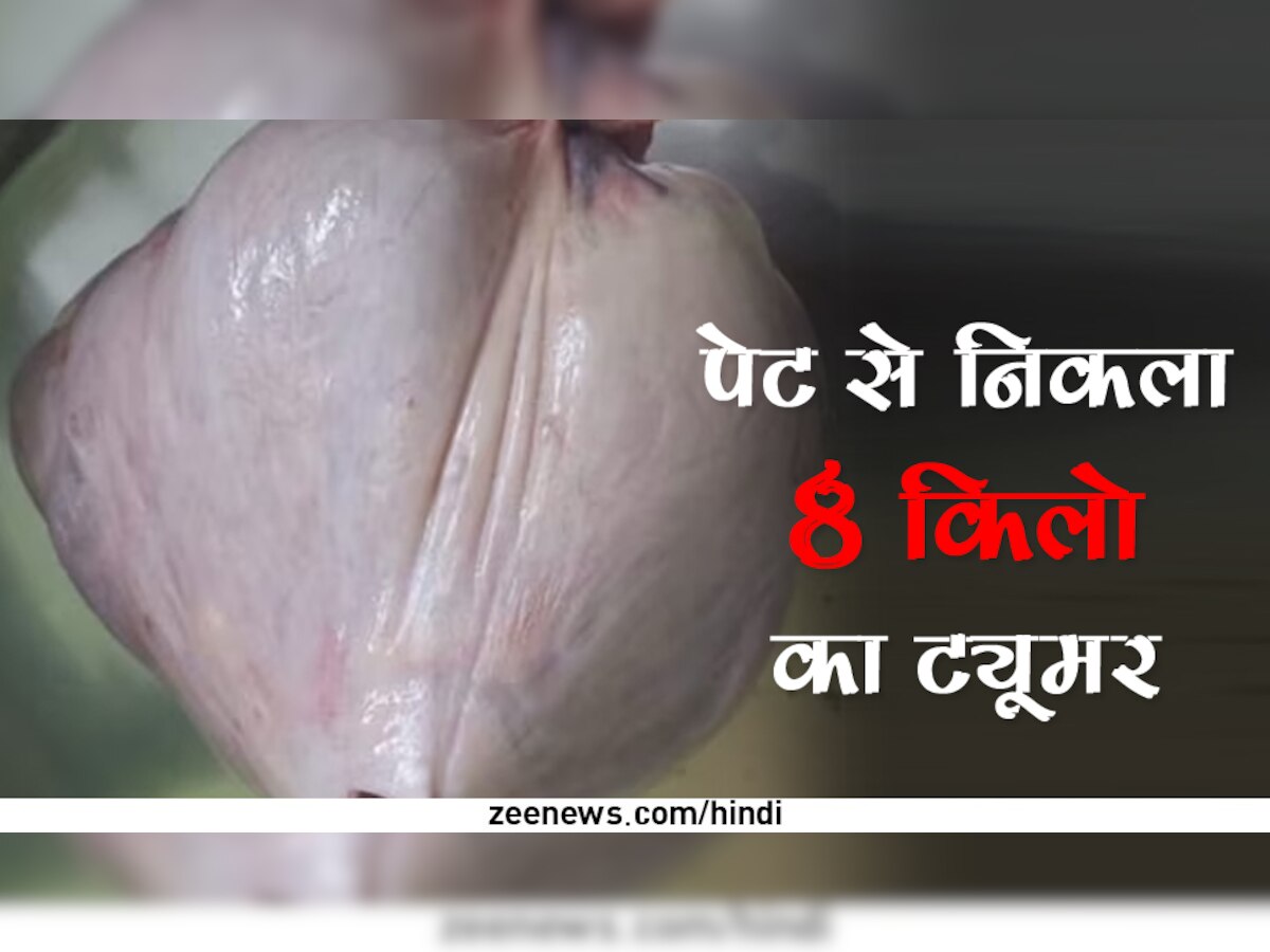 महिला के पेट से डॉक्टर ने निकाला 8 किलो का ट्यूमर, तस्वीर देखकर लोगों की आंखें निकली बाहर!