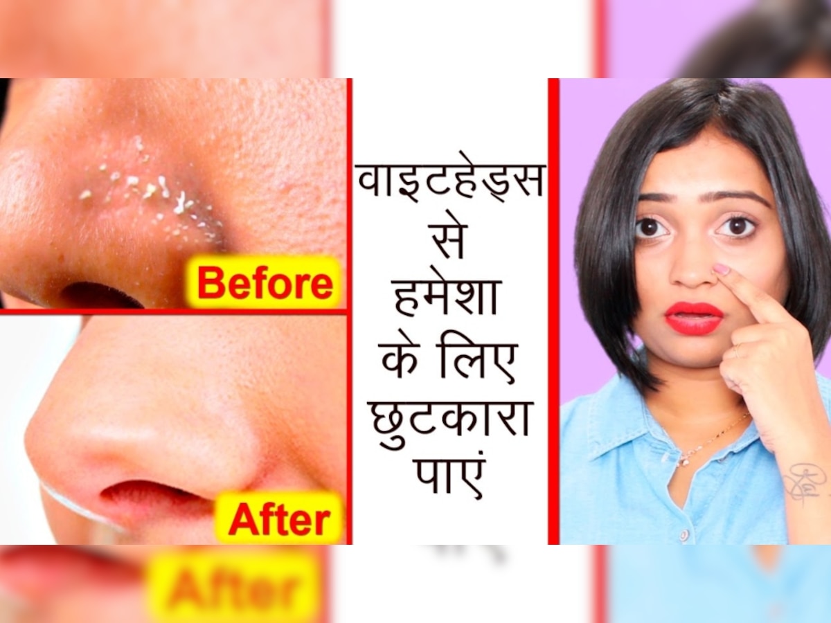 Whiteheads Solution: चेहरे पर मौजूद एक-एक Whiteheads जड़ से निकाल देगा ये आसान घरेलू नुस्खा