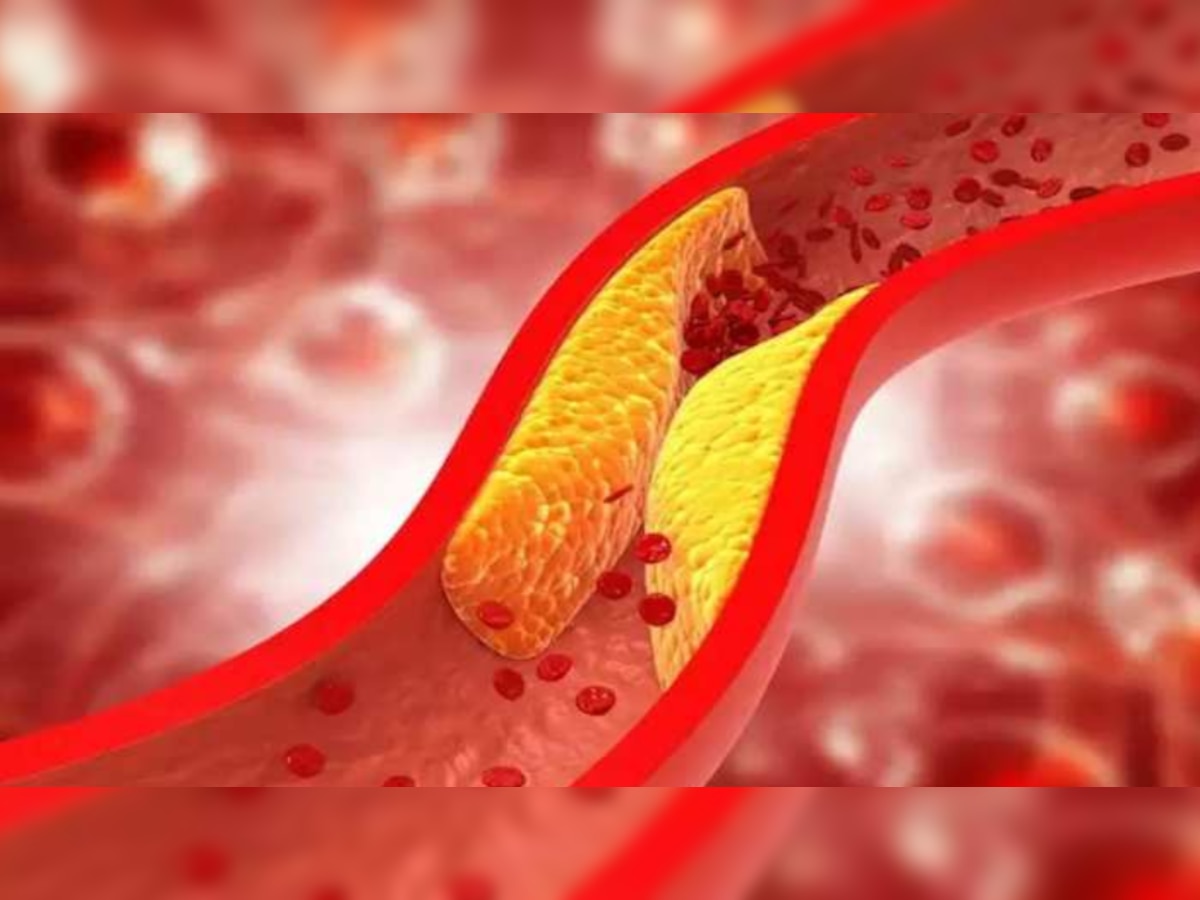 How to Reduce Bad Cholesterol : नसों में चिपके जिद्दी कोलेस्ट्रॉल को मिनटों में दूर कर देंगे ये करामाती बीज, ऐसे करें इस्‍तेमाल 