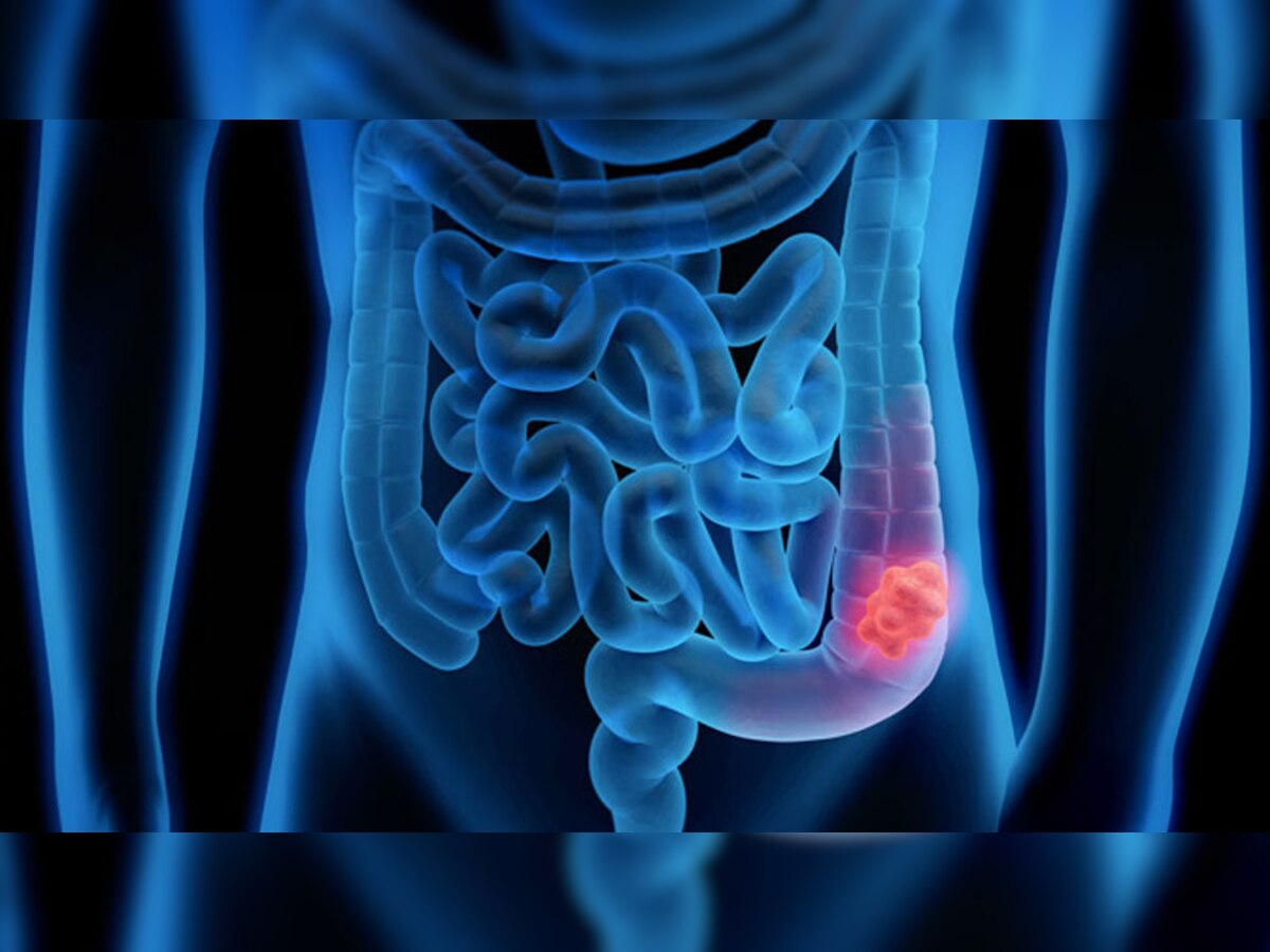 Colorectal Cancer: पेट के आसपास बननी लगे चर्बी तो हो जाएं अलर्ट? हो सकता है बड़ी आंत का कैंसर, आज ही इन चीजों से बना लें दूरी