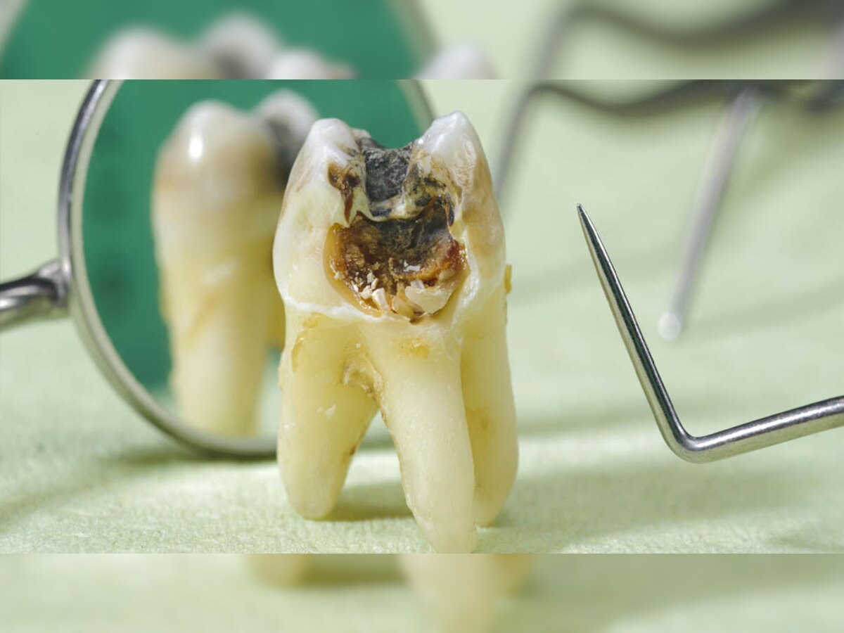 Teeth Cavities: दातों की समस्या रहेगी कोसो दूर, बस करने होंगे ये 5 काम