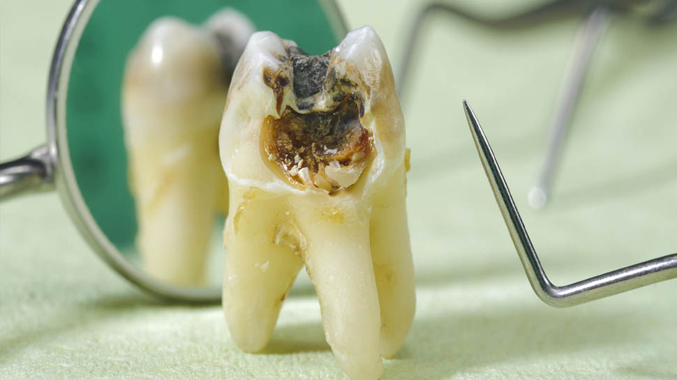 Teeth Cavities: दातों की समस्या रहेगी कोसो दूर, बस करने होंगे ये 5 काम Teeth Cavities: दातों की समस्या रहेगी कोसो दूर, बस करने होंगे ये 5 काम
