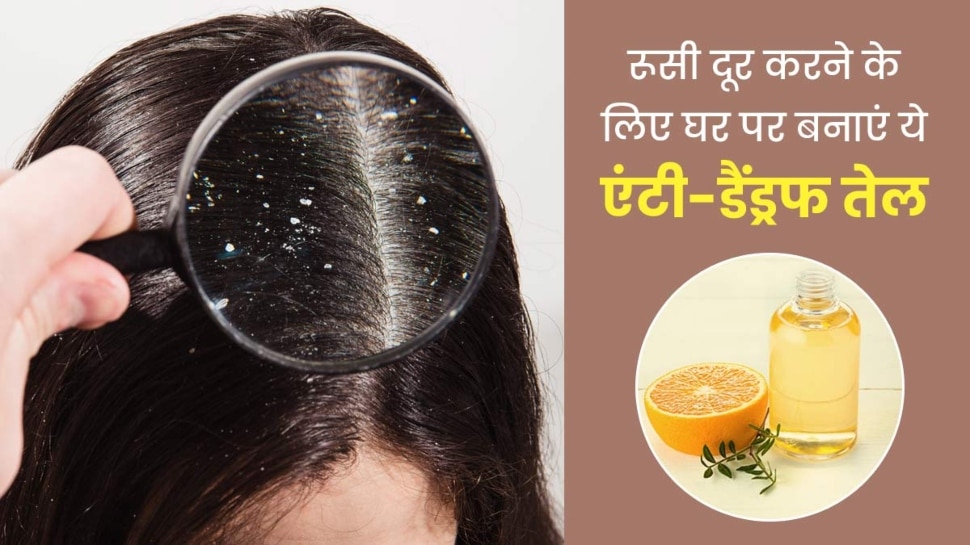 How To Make Anti Dandruff Oil Permanent Solution For Dandruff At Home |  Hindi News, इन 2 चीजों से घर पर बनाएं Anti Dandruff Oil, बालों से हो जाएगी  डेंड्रफ की छुट्टी