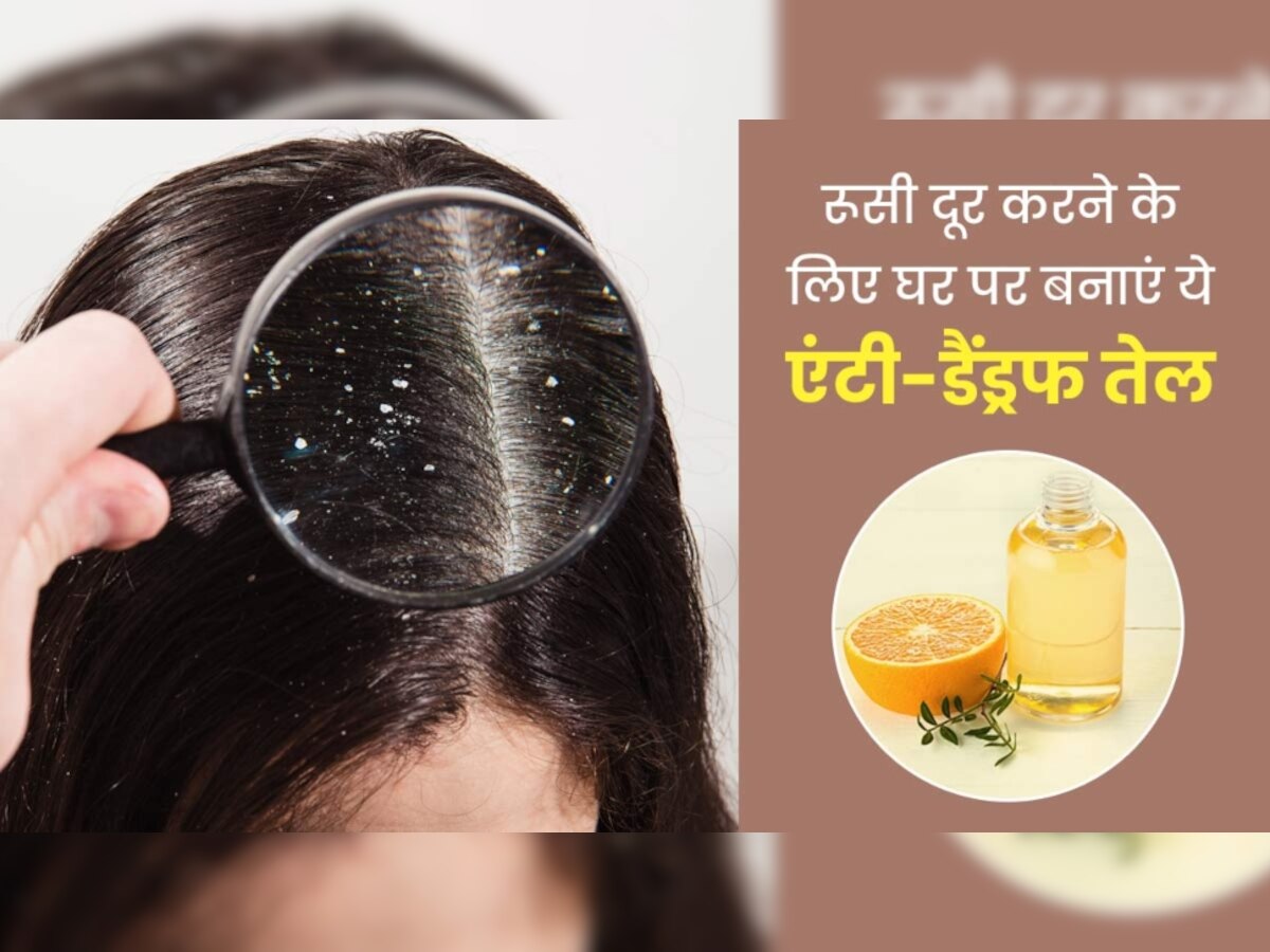 इन 2 चीजों से घर पर बनाएं Anti Dandruff Oil, बालों से हो जाएगी डेंड्रफ की छुट्टी