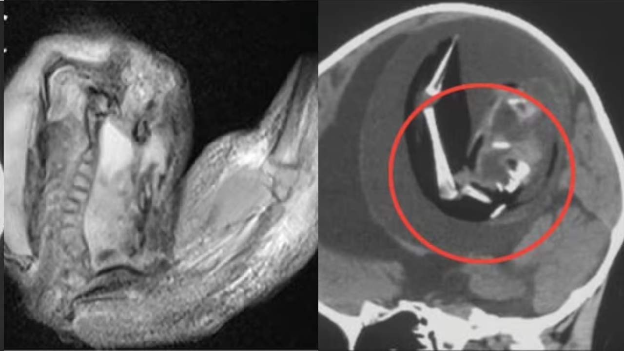 मेडिकल हिस्ट्री को हैरान कर देने वाला मामला आया सामने, 12 महीने की बच्ची के दिमाग में पल रहा था बच्चा