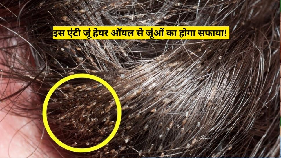 Anti Lice Hair Oil To Get Rid Of Hair Lice At Home Permanently Hindi News बालों में बोल दिया