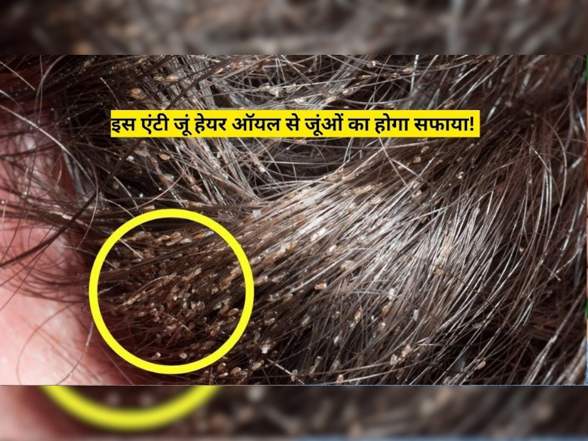 Hair Care Tips: बालों में बोल दिया है जूंओं ने हमला, घर पर बनाएं एंटी जूं हेयर ऑयल, जूंओं का होगा सफाया