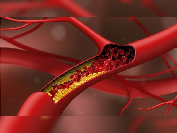 Reduce Cholesterol: बस इन 5 चीजों का रखें ध्यान, तेजी से कम होगा कोलेस्ट्रॉल