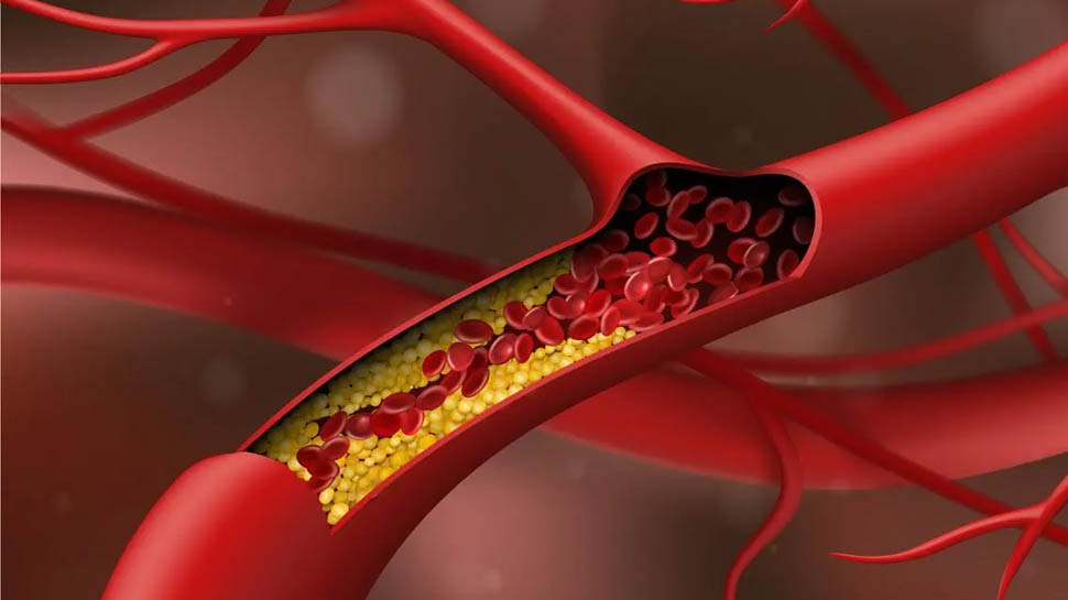 Reduce Cholesterol: बस इन 5 चीजों का रखें ध्यान, तेजी से कम होगा कोलेस्ट्रॉल Reduce Cholesterol: बस इन 5 चीजों का रखें ध्यान, तेजी से कम होगा कोलेस्ट्रॉल