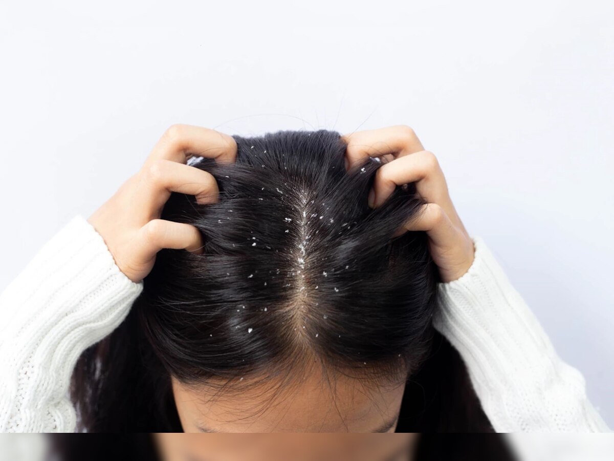 Reetha Hair Mask To Get Rid Of Dandruff Hair Care Tips Hindi News