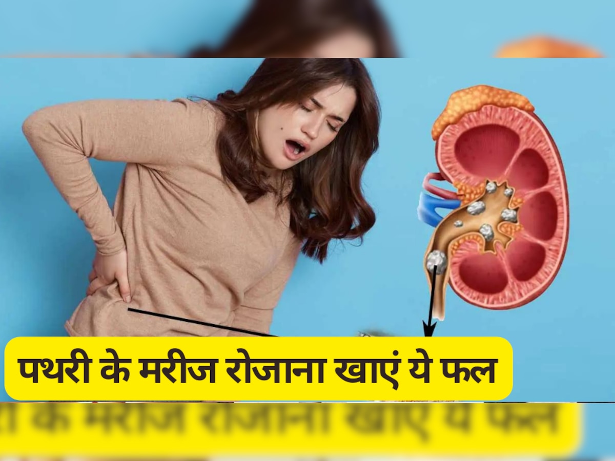 Kidney Stone: पथरी के मरीज रोजाना खाएं ये फल, नहीं पड़ेगी दवाई खाने की जरूरत 