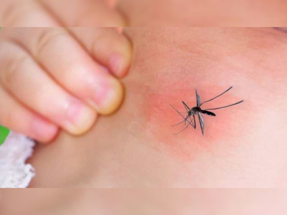 Dengue: डेंगू के इन लक्षणों से रखें खुद को अलर्ट, जानें इससे बचने के उपाय