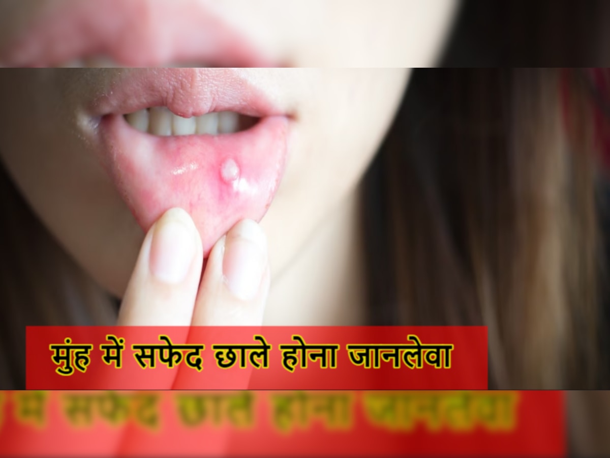 Mouth Infection: मुंह में निकलने वाले सफेद छालों को न करें नजरअंदाज, ये हो सकती हैं बड़ी वजह!