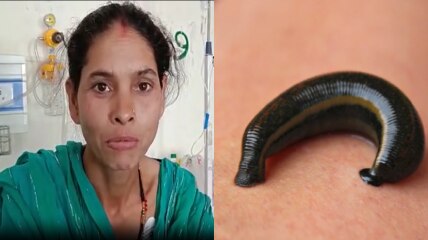 OMG! महिला के मुंह से निकली 5 cm लंबी जिंदा जोंक, खून चूसकर शरीर को कर रही थी खोखला, डॉक्टरों ने घंटों ऑपरेशन कर बाहर निकाला