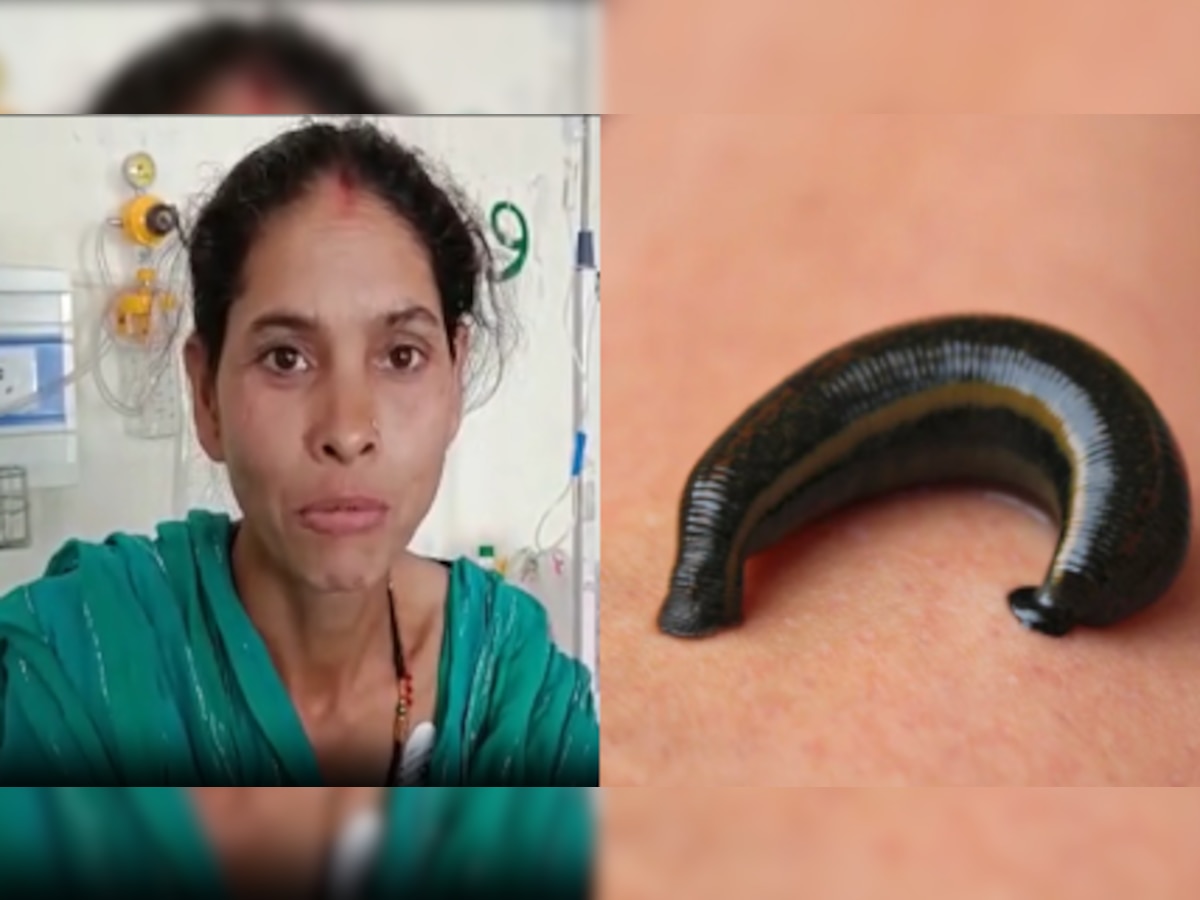  महिला के मुंह से निकली 5 cm लंबी जिंदा जोंक