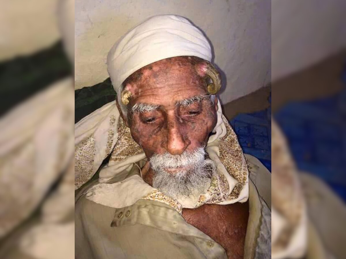 Worlds oldest man with two horn like growths on head dies yemen ali