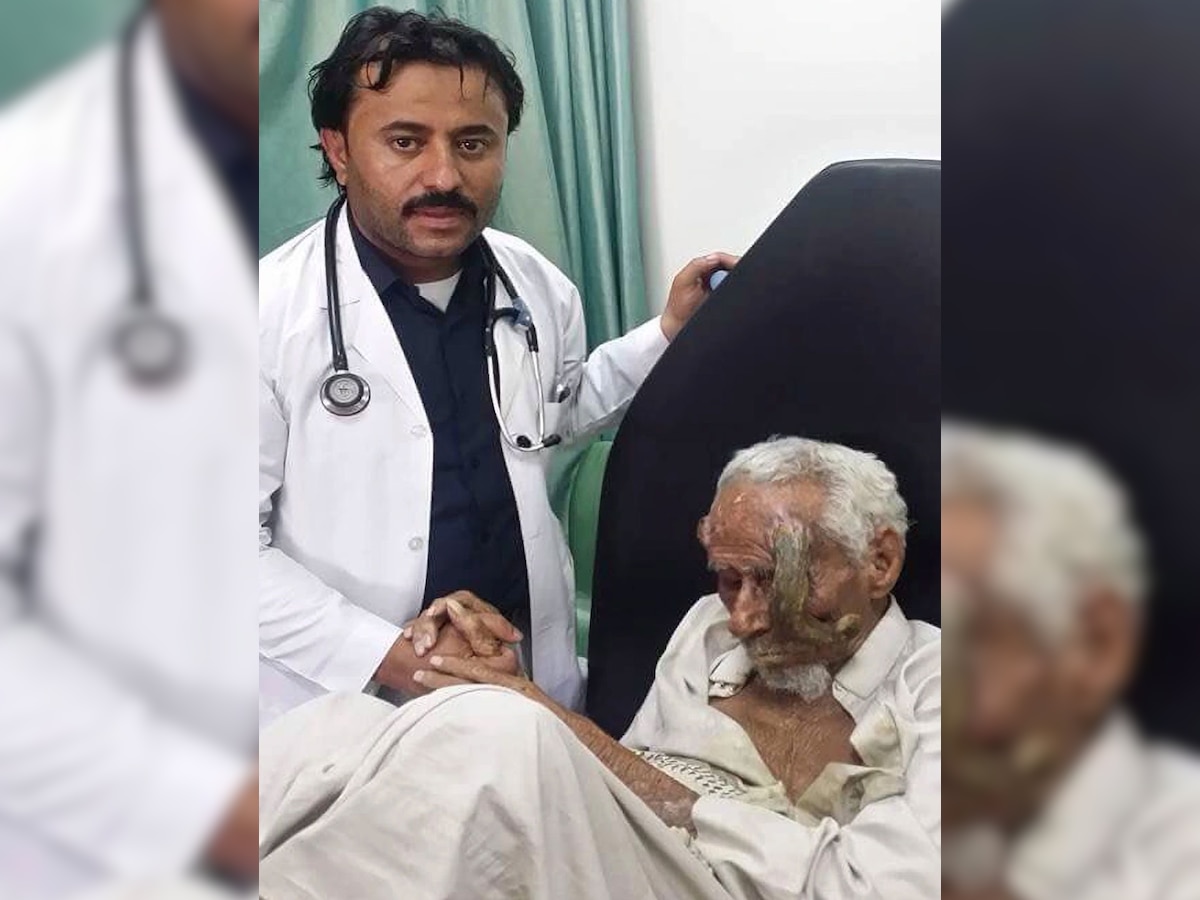 Worlds oldest man with two horn like growths on head dies yemen ali