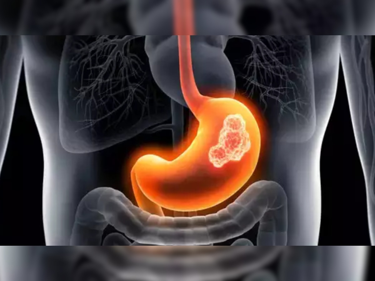 Stomach Cancer: पेट के दर्द को ना करें नजरअदांज, ये हो सकते हैं पेट कैंसर के लक्षण!