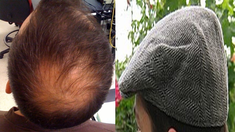 Wearing a Hat Cause Hair Loss know the exact reason behind it Wearing a Hat Cause Hair Loss