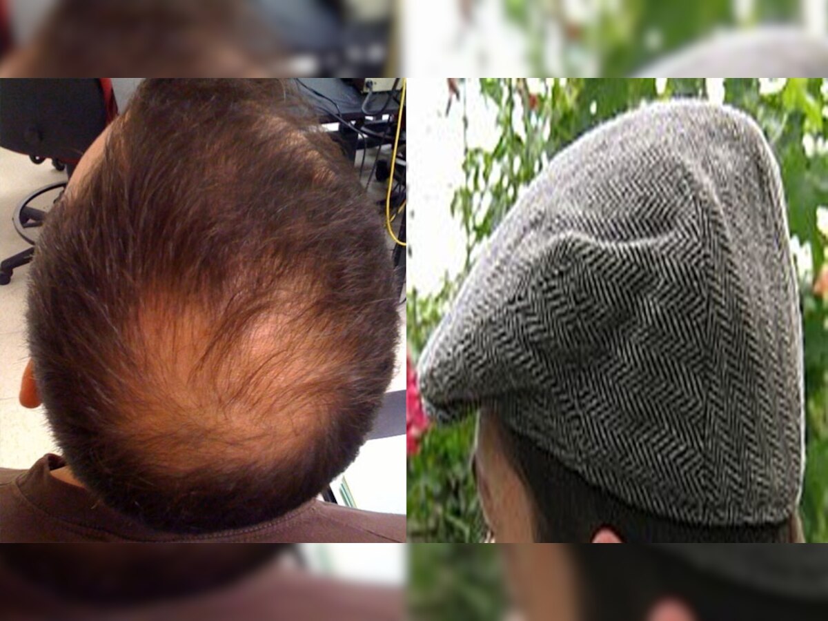 Wearing a Hat Cause Hair Loss: क्या टोपी पहनने से होता है हेयर लॉस? ये है असली वजह