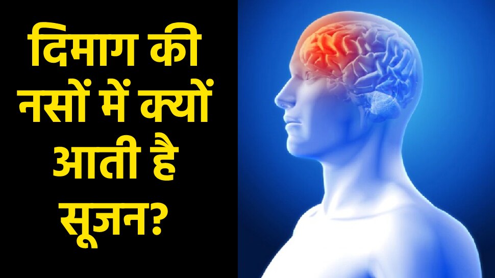 Brain AVM why swelling occur in brain veins note down these 5 warning